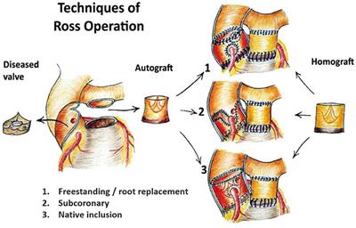 Understanding Pulmonary Autograft Remodeling After the Ross Procedure: Stick to the Facts
